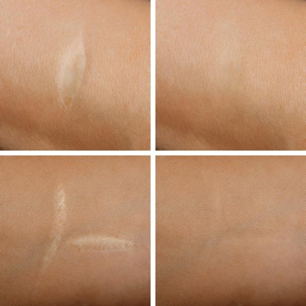 Removal of scars on the skin
