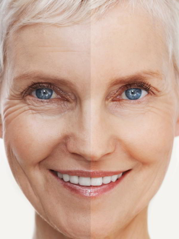 Age Spots Treatment